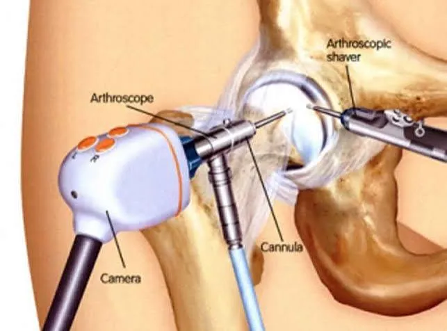 Choque femoroacetabular: diagnóstico de las deformidades CAM y PINCER