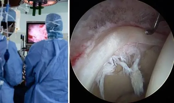 Reparación del labrum acetabular: anclajes, sellado y control dinámico