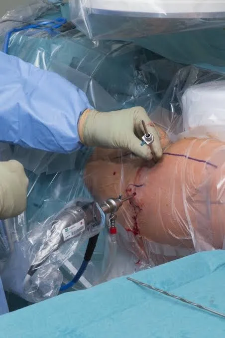 Reconstrucción del labrum con injerto: cuándo reparar ya no es posible