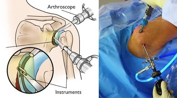 Reparación del subescapular: el tendón olvidado del manguito rotador
