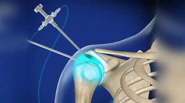 Capsulitis adhesiva: cuándo indicar la liberación capsular artroscópica