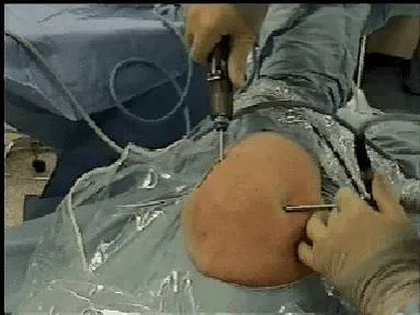 Tendinopatía calcificante del manguito: evacuación artroscópica de la calcificación