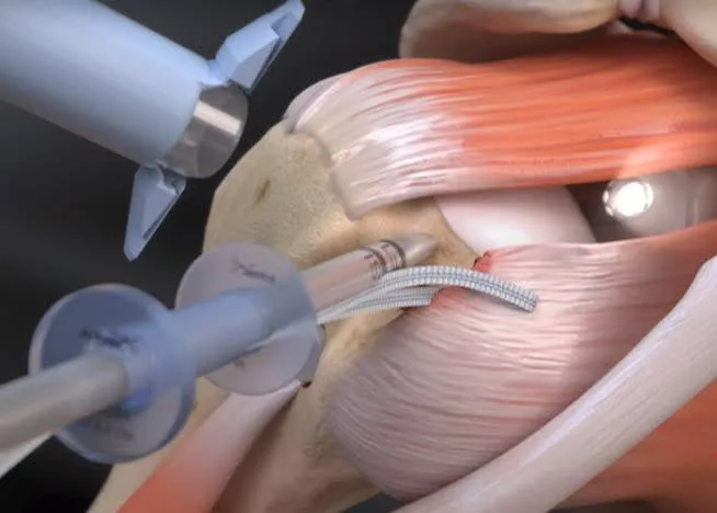 Silla de playa o decúbito lateral: implicaciones para cirujano, anestesia y enfermería
