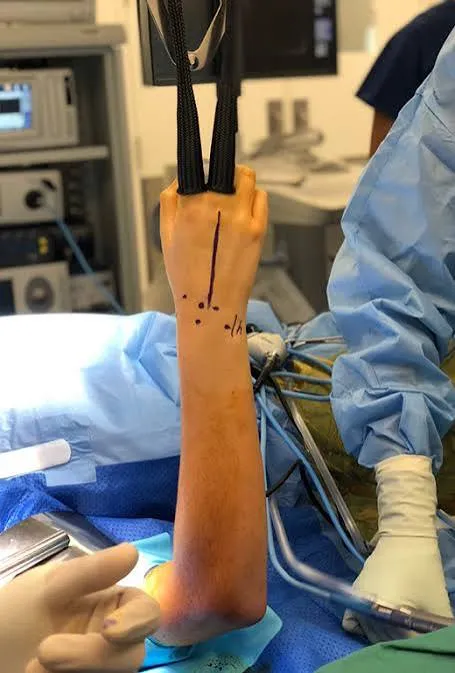 Artroscopia radiocarpiana en la muñeca del deportista de raqueta