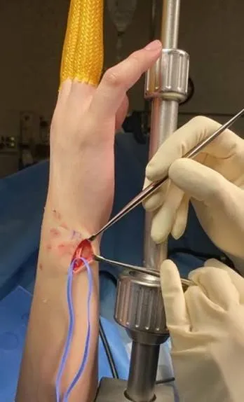 Terapia de mano tras artroscopia de muñeca: lo que acelera los resultados