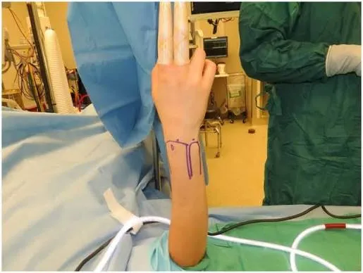 Artroscopia de muñeca: TFCC, gangliones y fracturas de radio distal