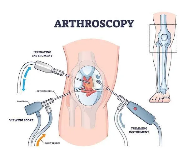 Osteotomía y artroscopia combinadas en la rodilla varo del joven