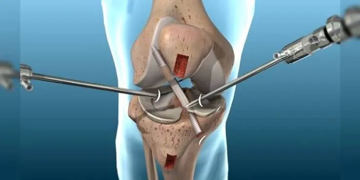 Derrame y hemartrosis tras artroscopia de rodilla: manejo práctico