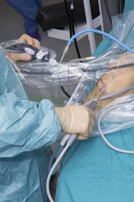 Tenodesis extraarticular lateral en la plastia de LCA: cuándo añadirla