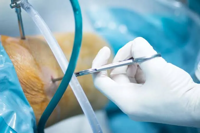 Enfermería en la artroscopia de rodilla: montaje, instrumentación y checklist