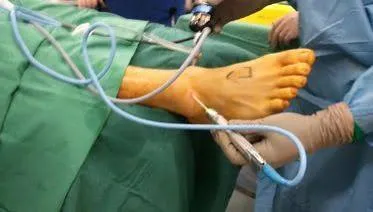 Artroscopia de tobillo: pinzamiento, lesiones osteocondrales e inestabilidad