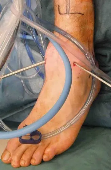 Lesiones osteocondrales del astrágalo: algoritmo de tratamiento artroscópico